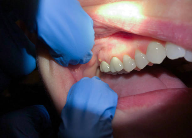 Best Knocked-Out Tooth Emergency  in Venersborg, WA
