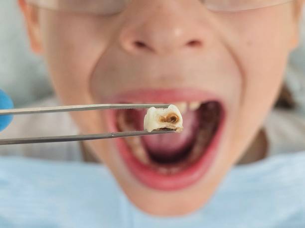 Best Chipped Tooth Repair Near Me  in Venersborg, WA